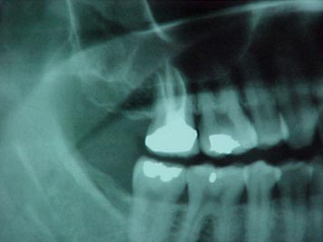 Dental Root canals are believed to create an environment for chronic infection and toxins.